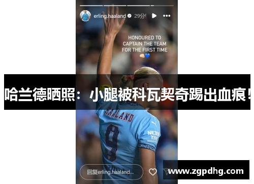 哈兰德晒照：小腿被科瓦契奇踢出血痕！